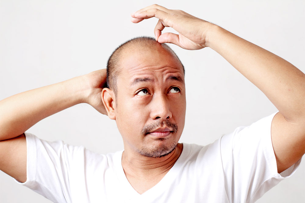 7 Ways to Treat Male Pattern Baldness at Home