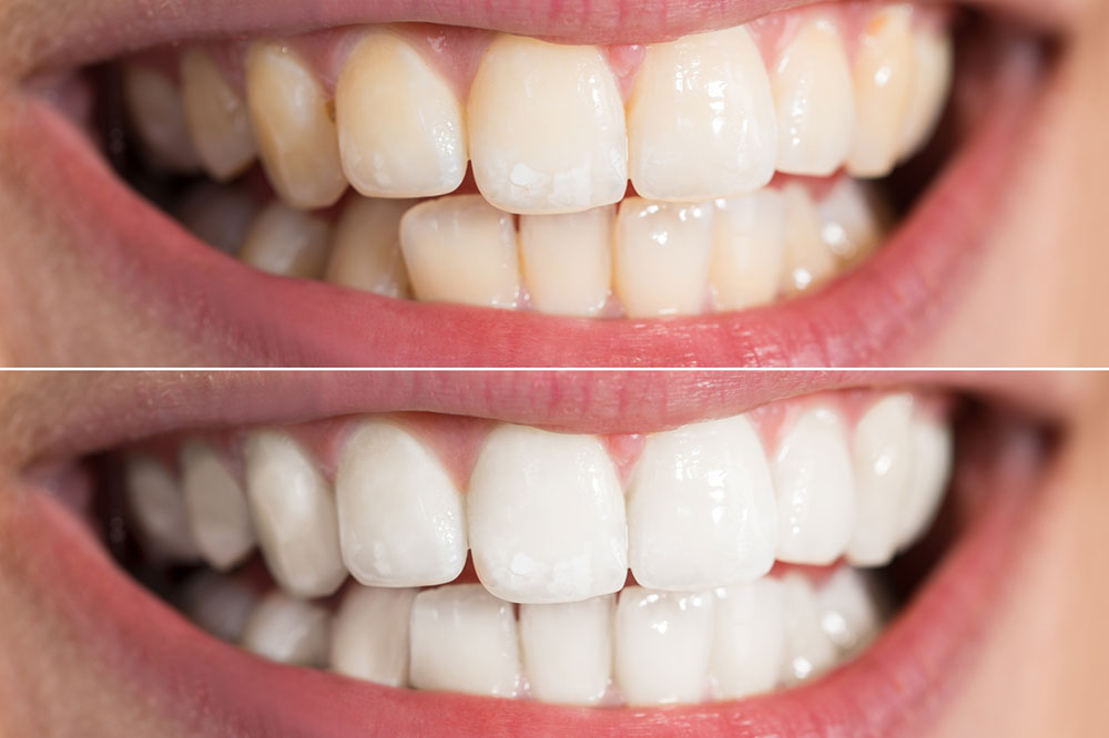 5 Simple Ways to Whiten Teeth at Home