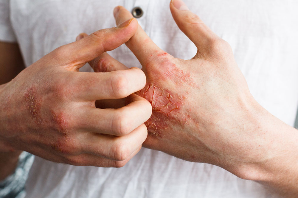 8 Effective Dietary Tips to Manage Eczema