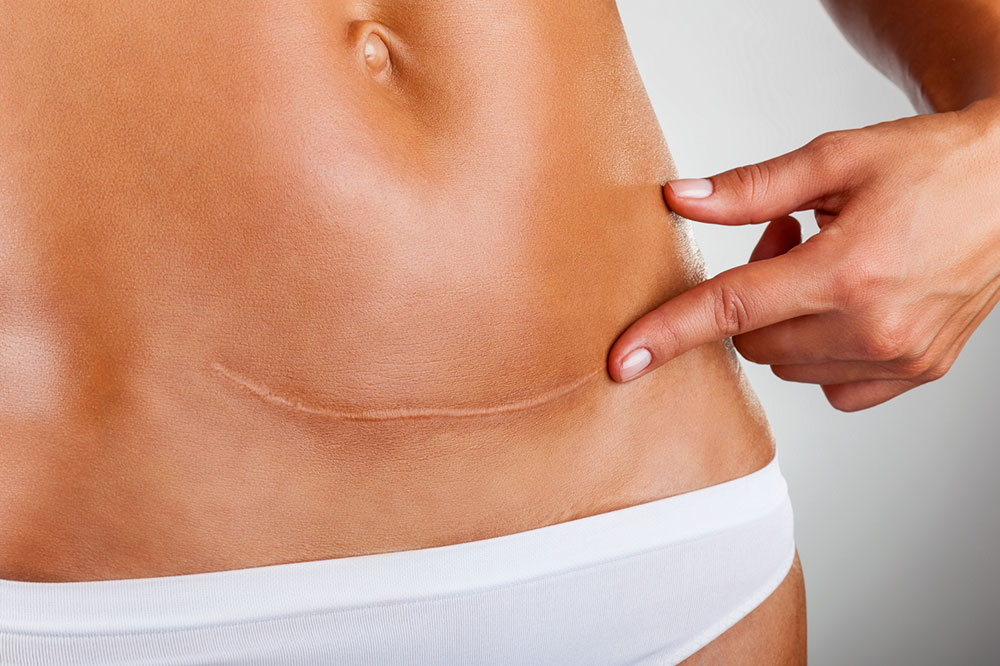 Effective Treatments for Ovarian Cancer